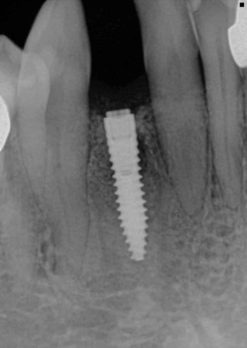 Dental Implants Pocatello Idaho