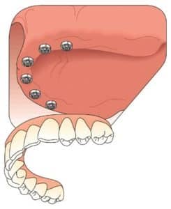Dental Implants in Pocatello Idaho