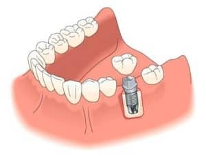 Dental Implants Pocatello ID