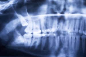 Winter is Coming…Time to Talk Wisdom Tooth Extractions