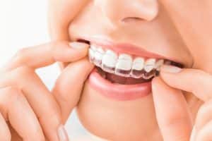 SureSmile Aligners