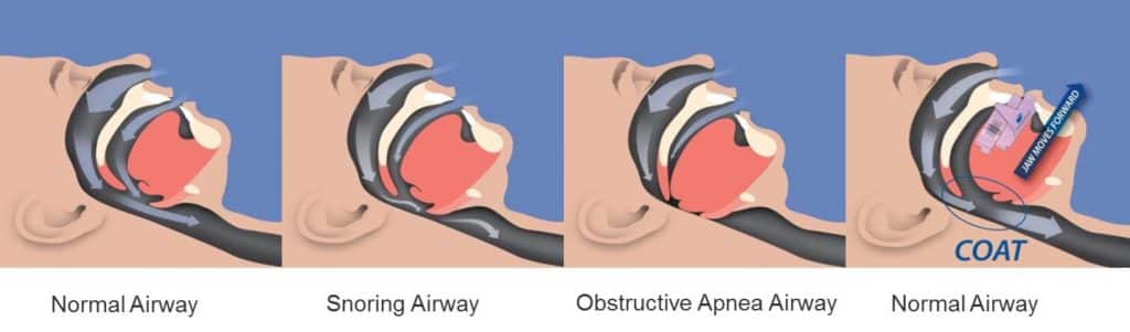 Sleep Apnea Therapy Sleep Apnea Therapy