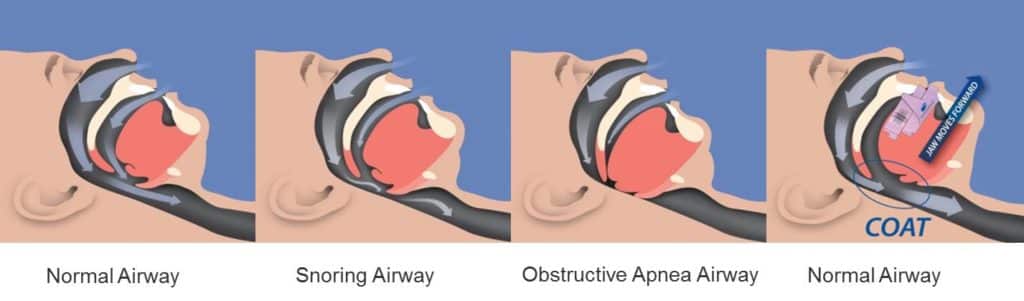 Sleep Apnea Therapy