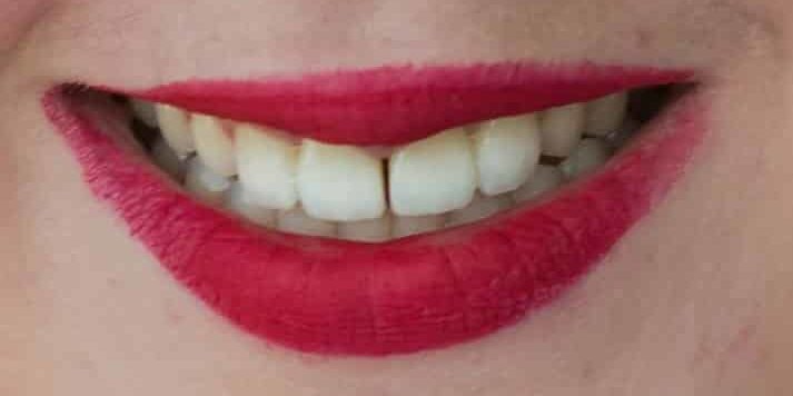 Smile Gallery