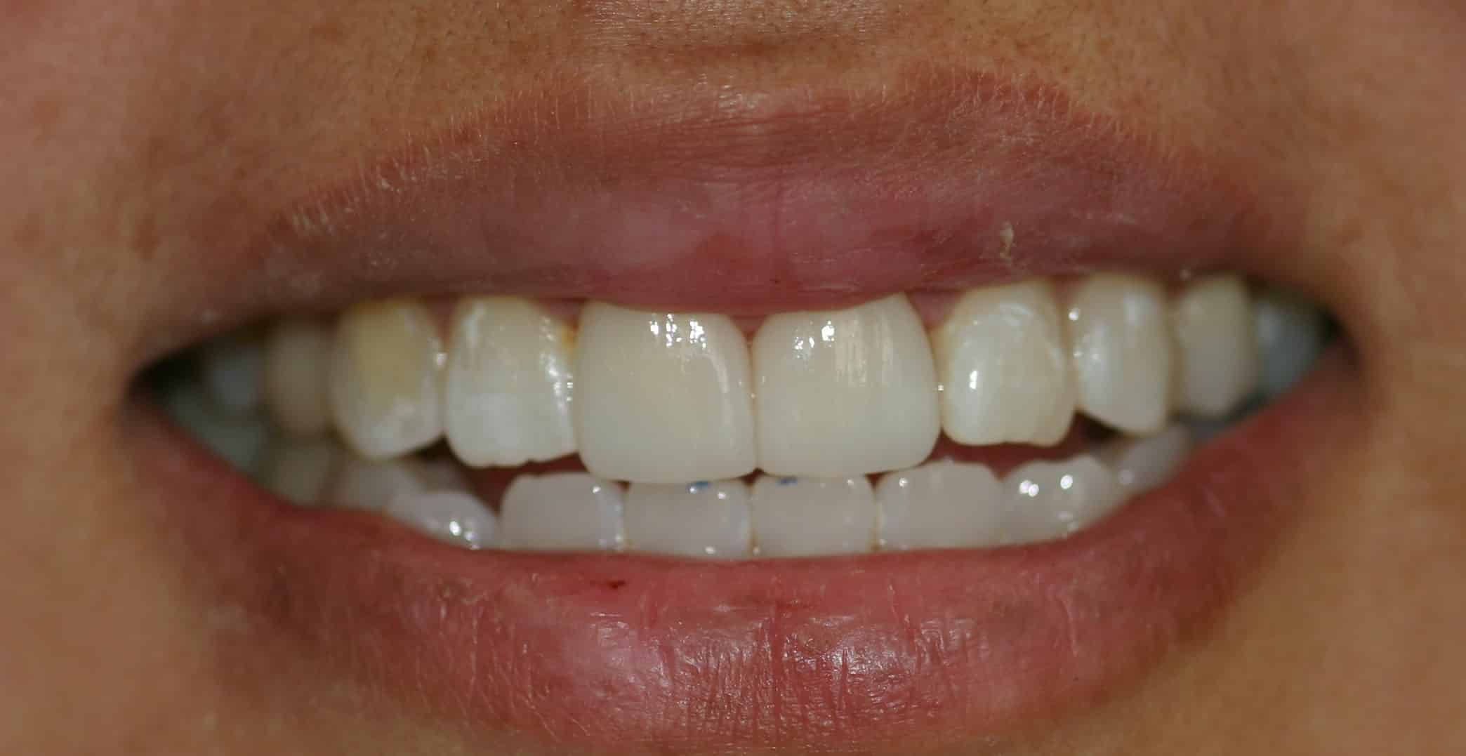 Smile Gallery