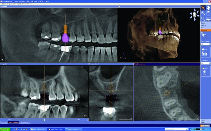 dental implants leavitt dentistry pocatello