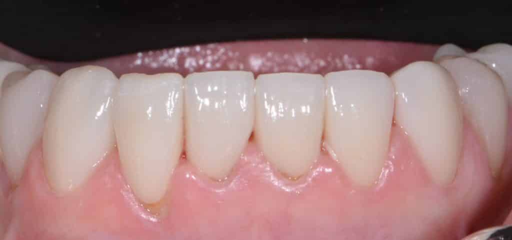 Porcelain Veneers Leavitt Dentistry Pocatello, ID