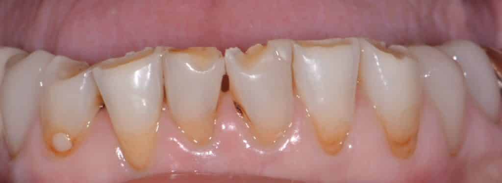 Porcelain Veneers Leavitt Dentistry Pocatello, ID