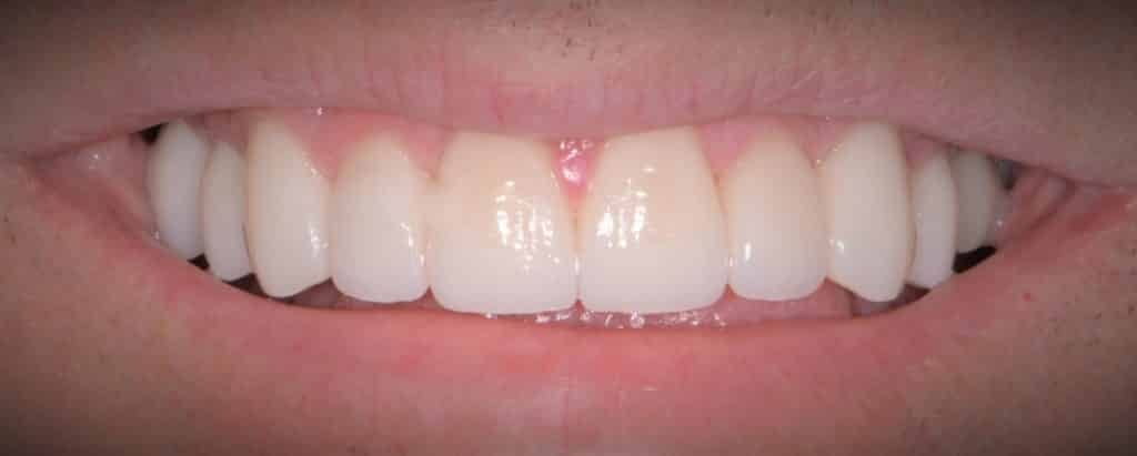Porcelain Veneers Leavitt Dentistry Pocatello, ID