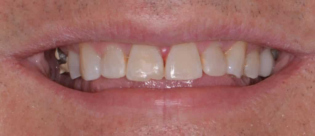 Porcelain Veneers Leavitt Dentistry Pocatello, ID