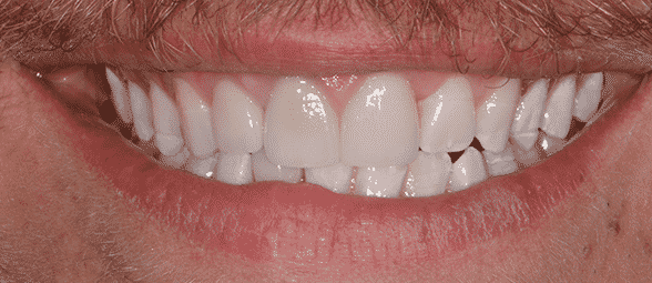 Do I have to shave down my teeth to get veneers?