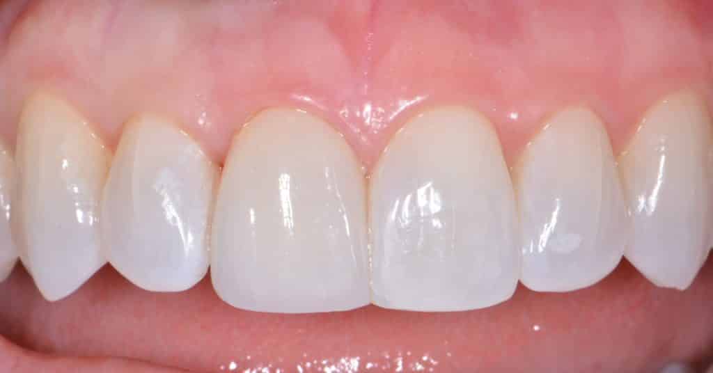 Front Tooth Filling Case Study
