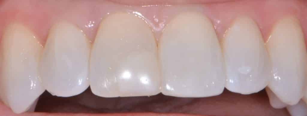 Front Tooth Filling Case Study