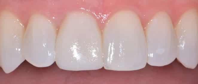 Front Tooth Filling Case Study