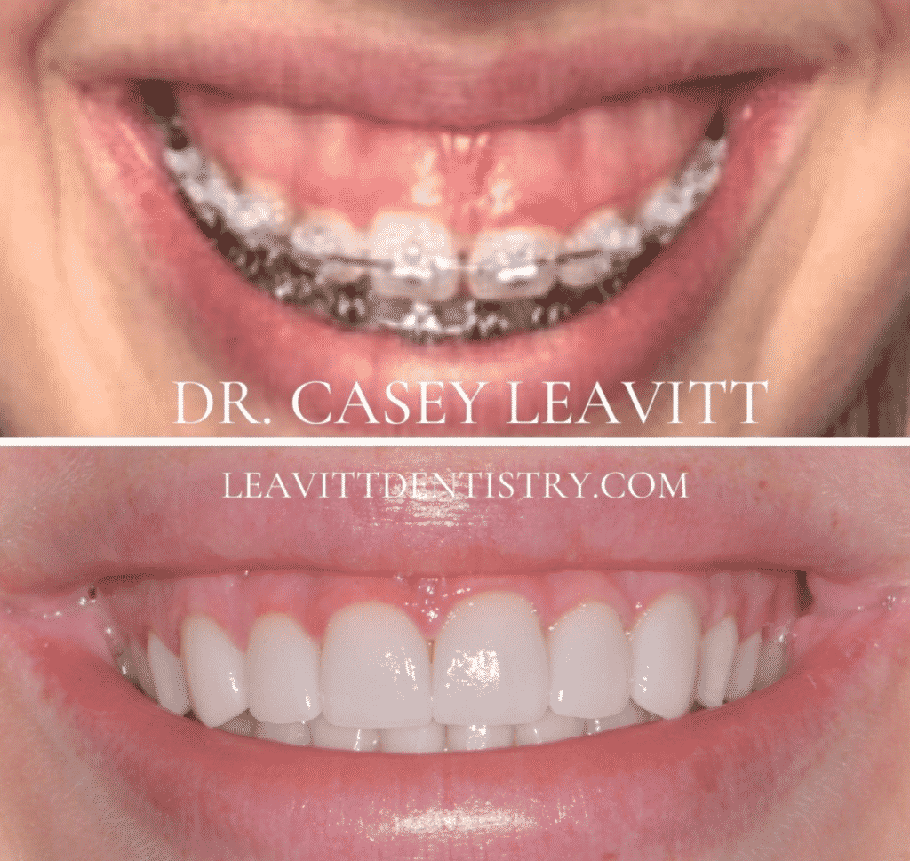 Smile Lift and Veneers