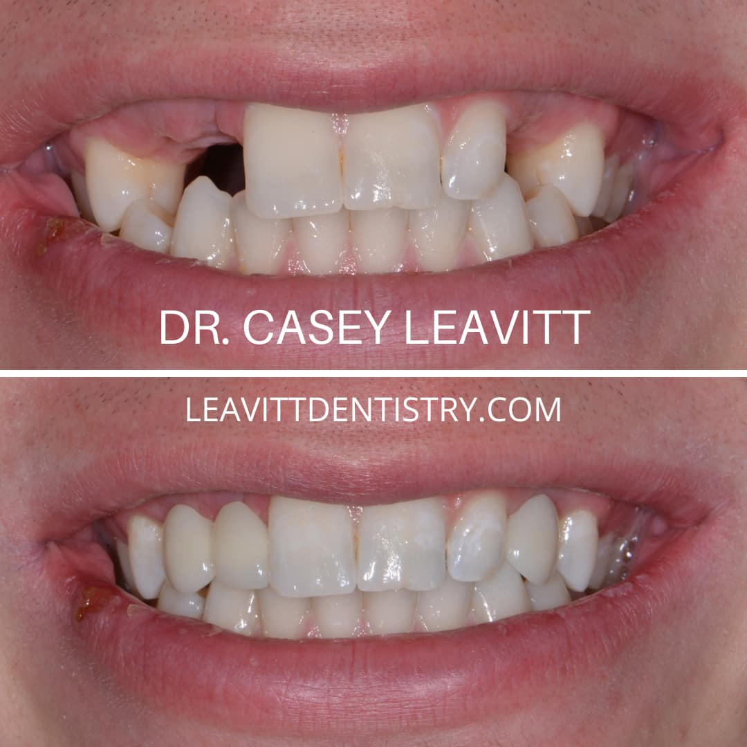 Implants And Ceramic Crowns Pocatello, ID Smile Gallery