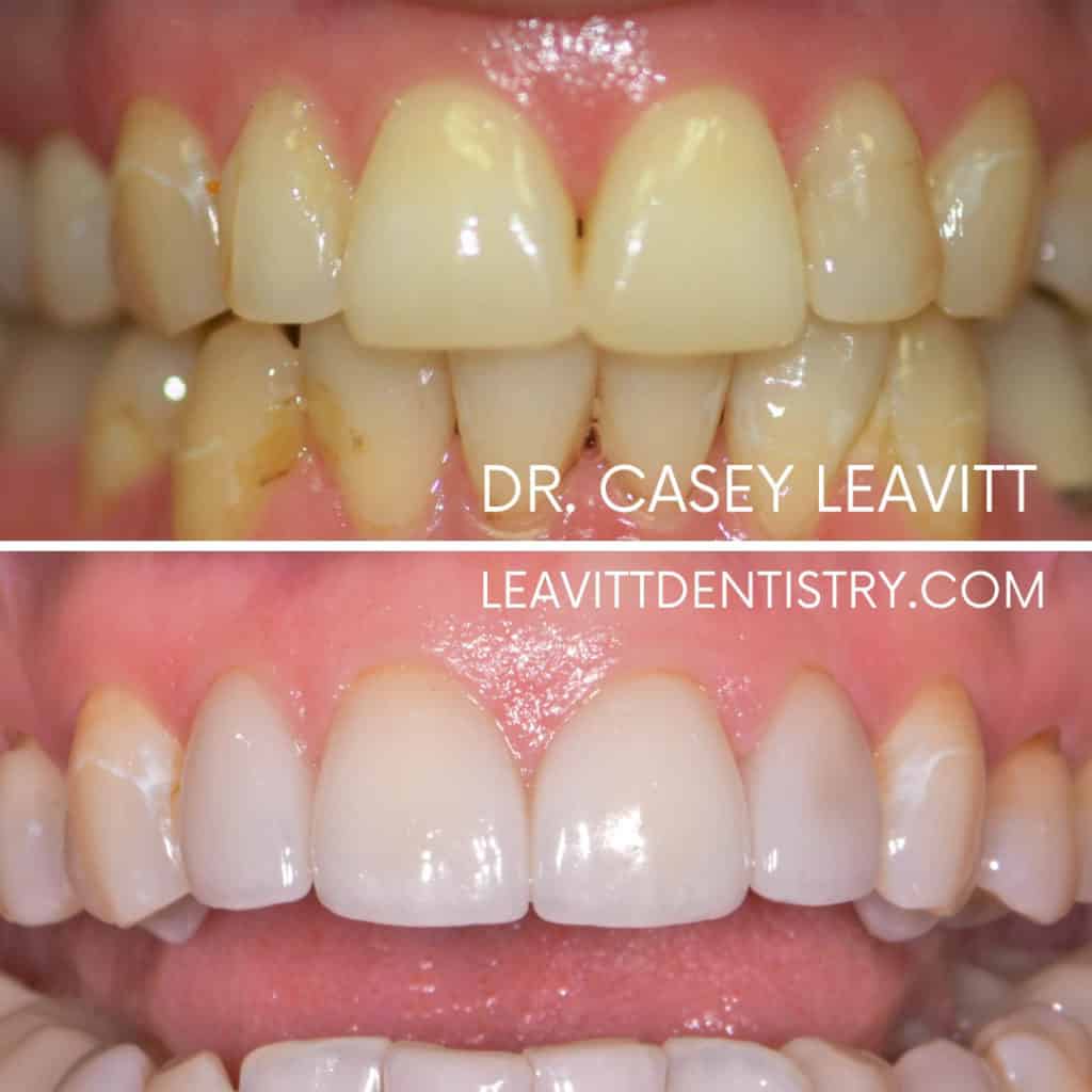 Custom Teeth Whitening and 4 Veneers