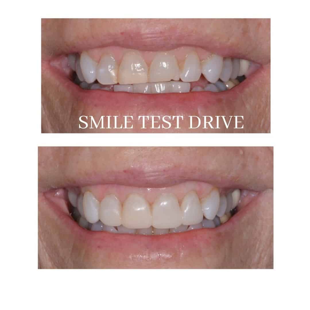 30 Minute Smile Test Drive Pocatello, ID Smile Gallery