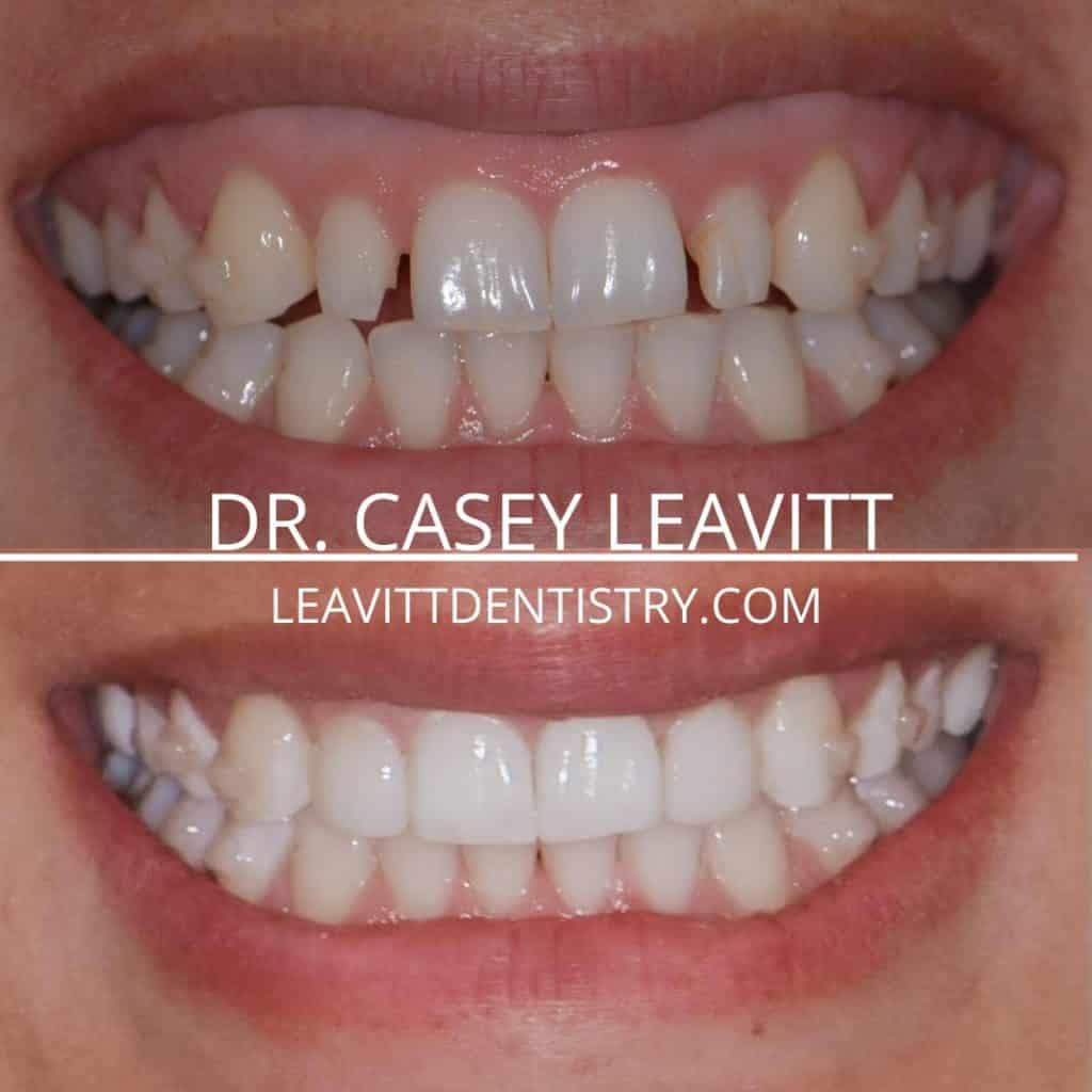 2 Veneers and SureSmile Clear Aligners