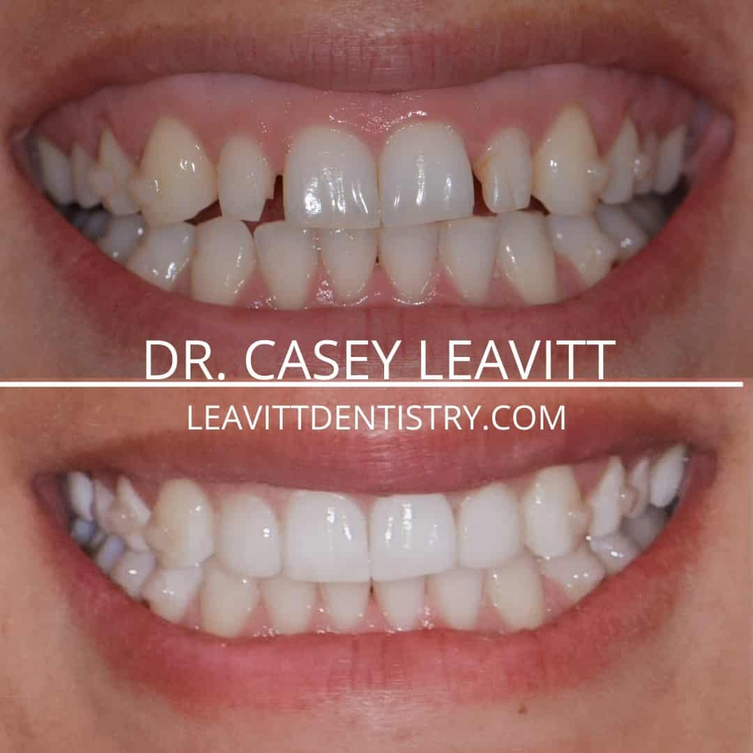 2 Veneers And Suresmile Clear Aligners Pocatello, ID Smile Gallery