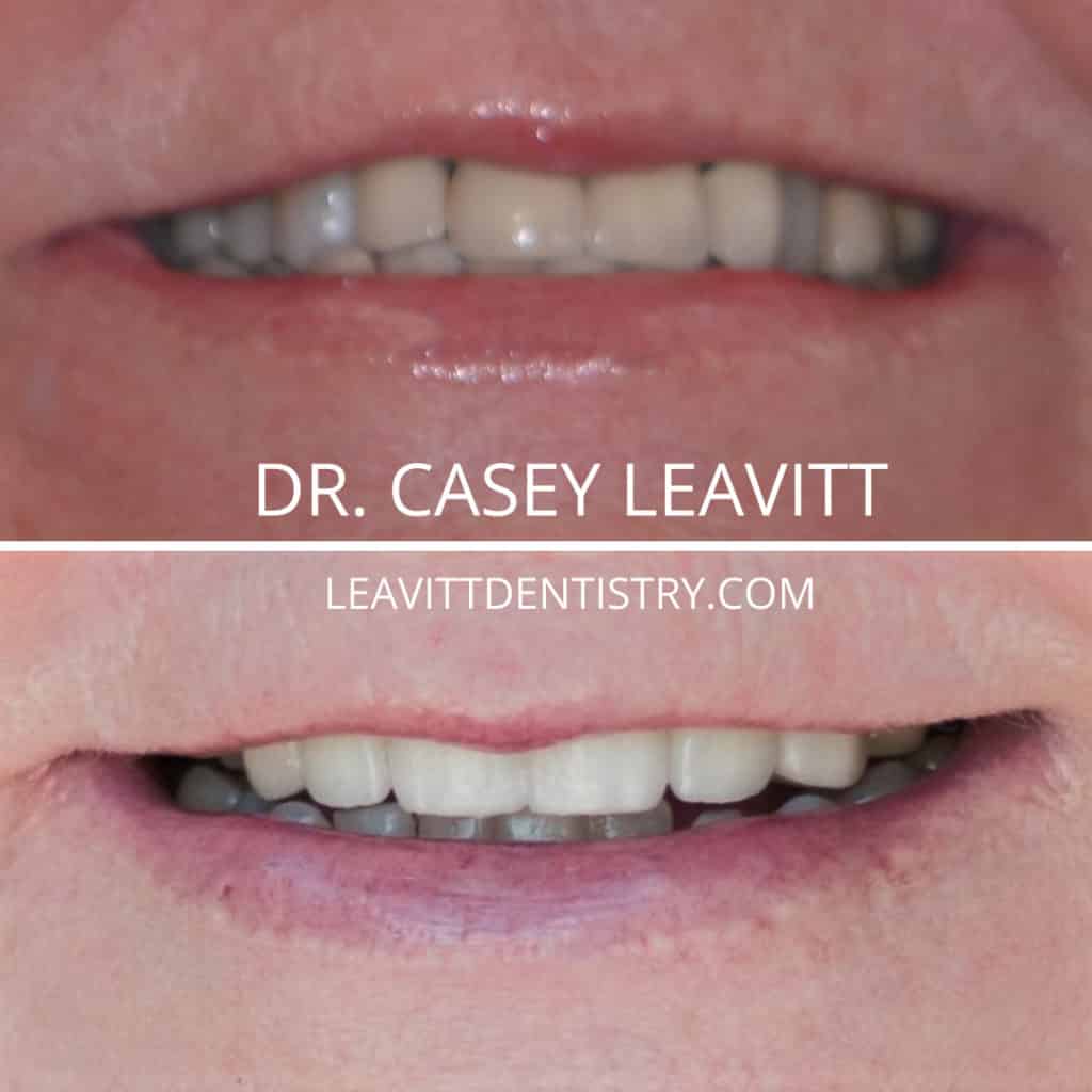 Crowns Creating an Updated and Beautiful Smile