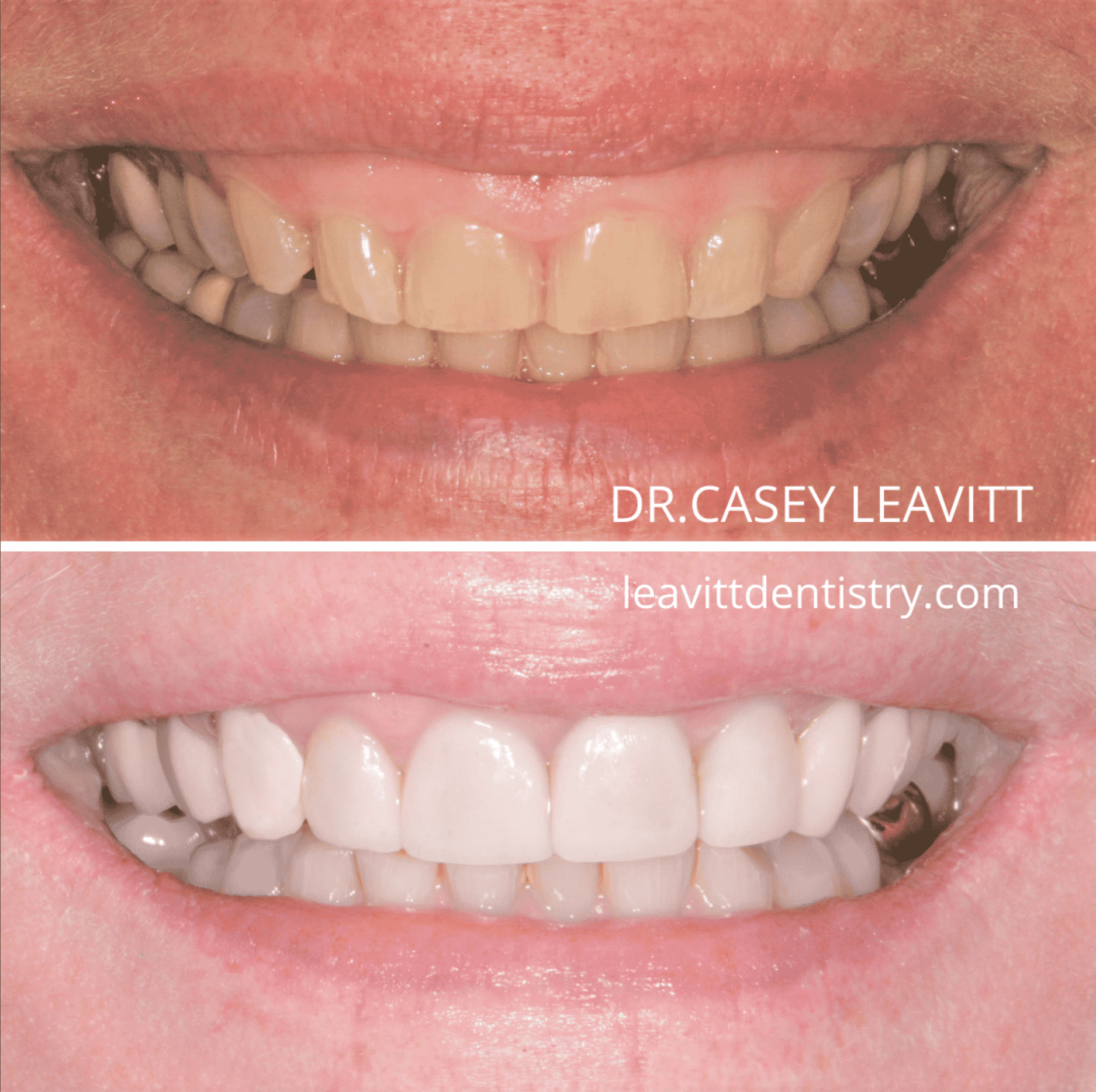 8 Veneers And A Gum Lift Leavitt Dentistry