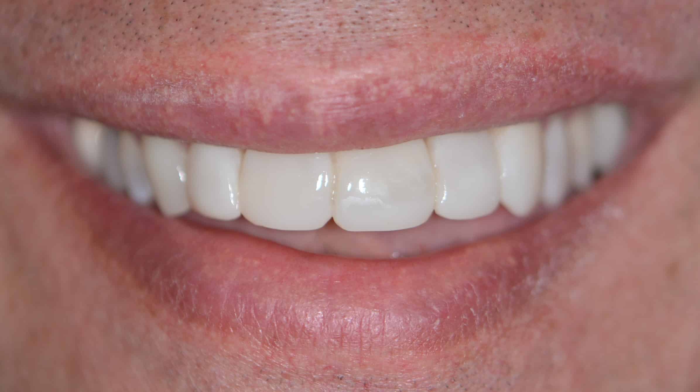 Is it possible to make my teeth all the same color and length?