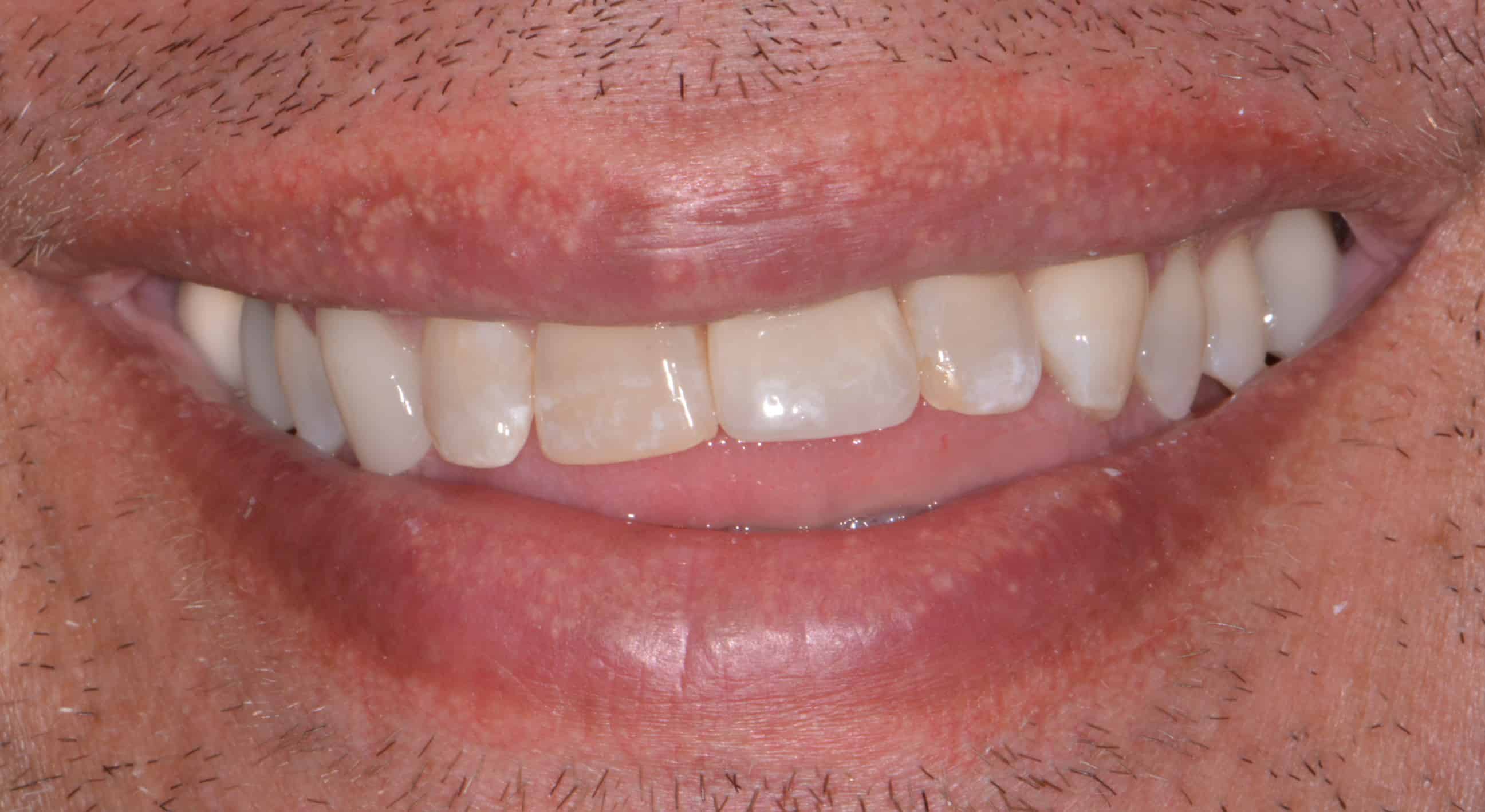 Is It Possible To Make My Teeth All The Same Color And Length? Is it possible to make my teeth all the same color and length?