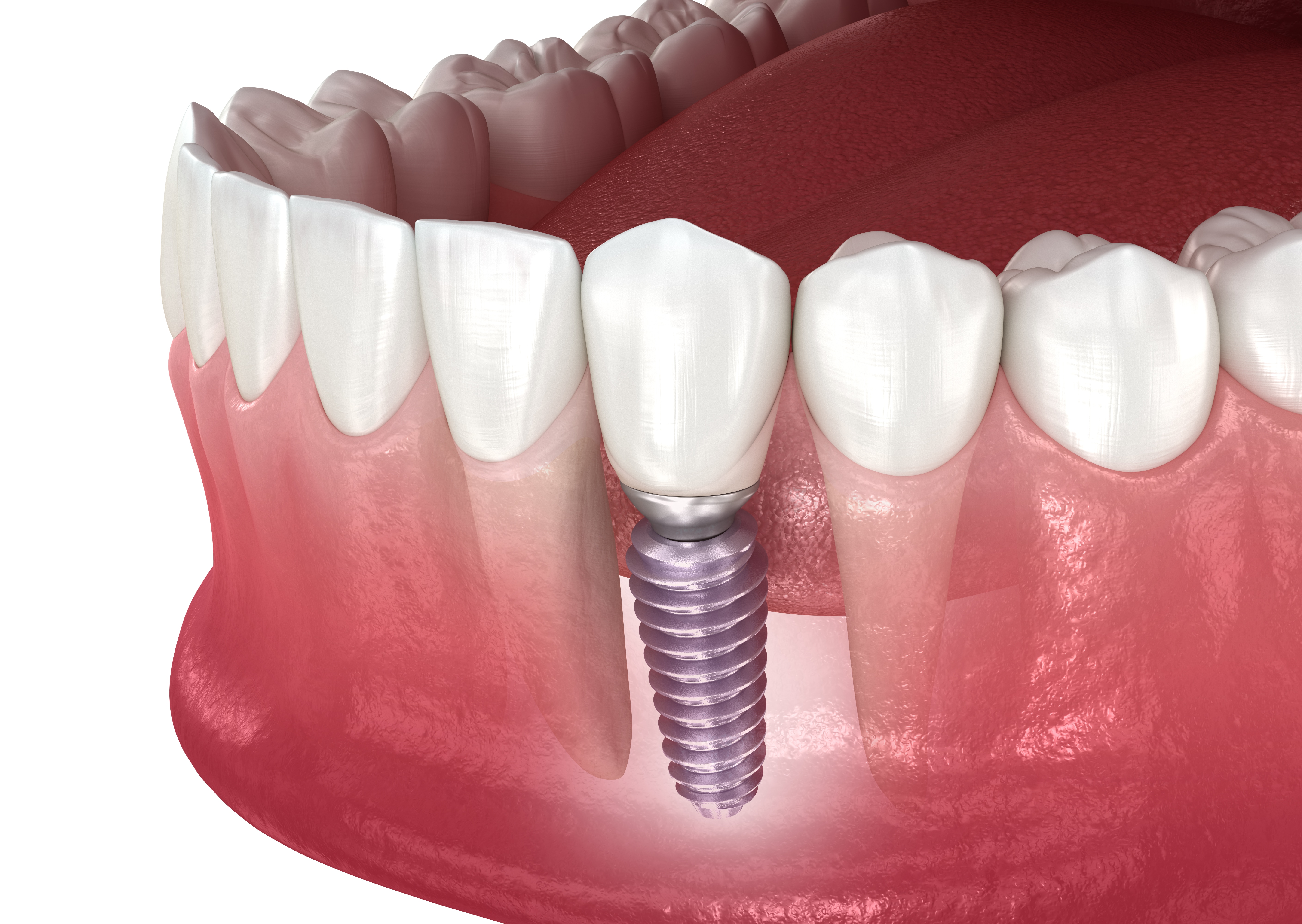 Exploring Dental Implant Options For Missing Teeth missing teeth Pocatello ID