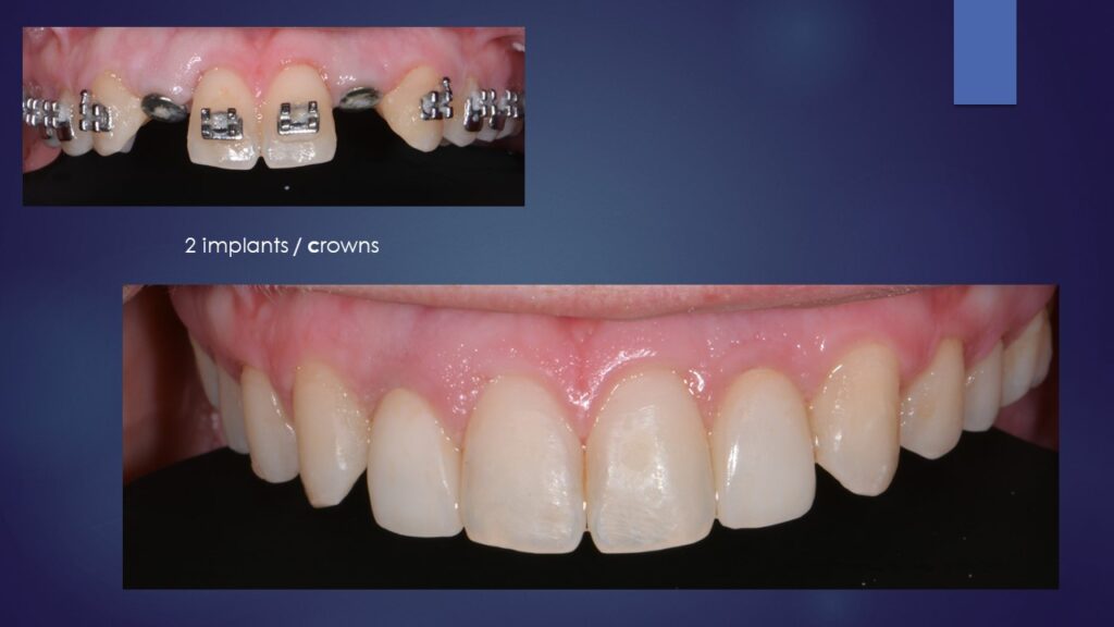 5 Red Flags To Avoid When Searching For “Dental Implants Near Me” Dental Implants Near Me