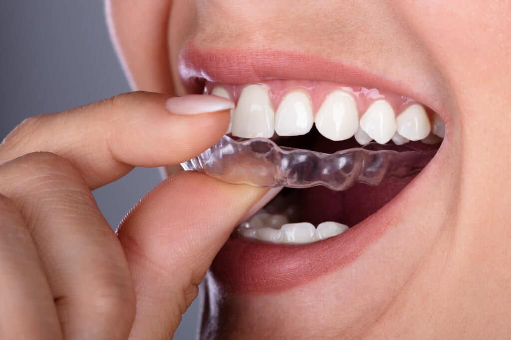 Clear Aligners vs. Braces: Which Is Best For You?