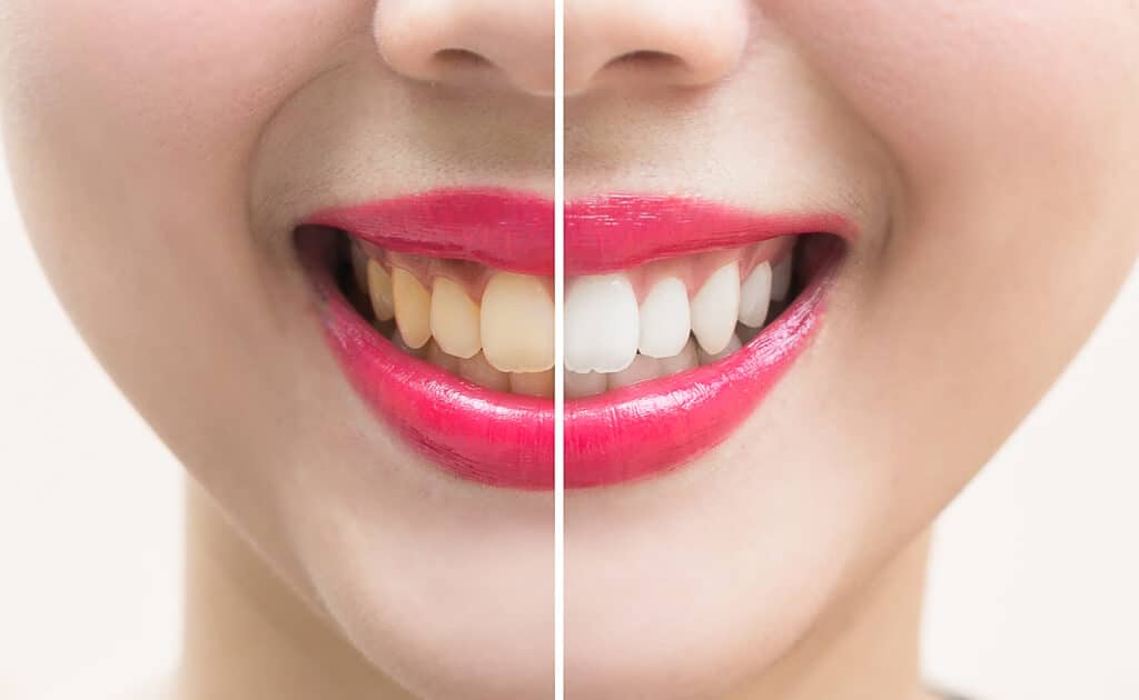 teeth whitening Pocatello ID