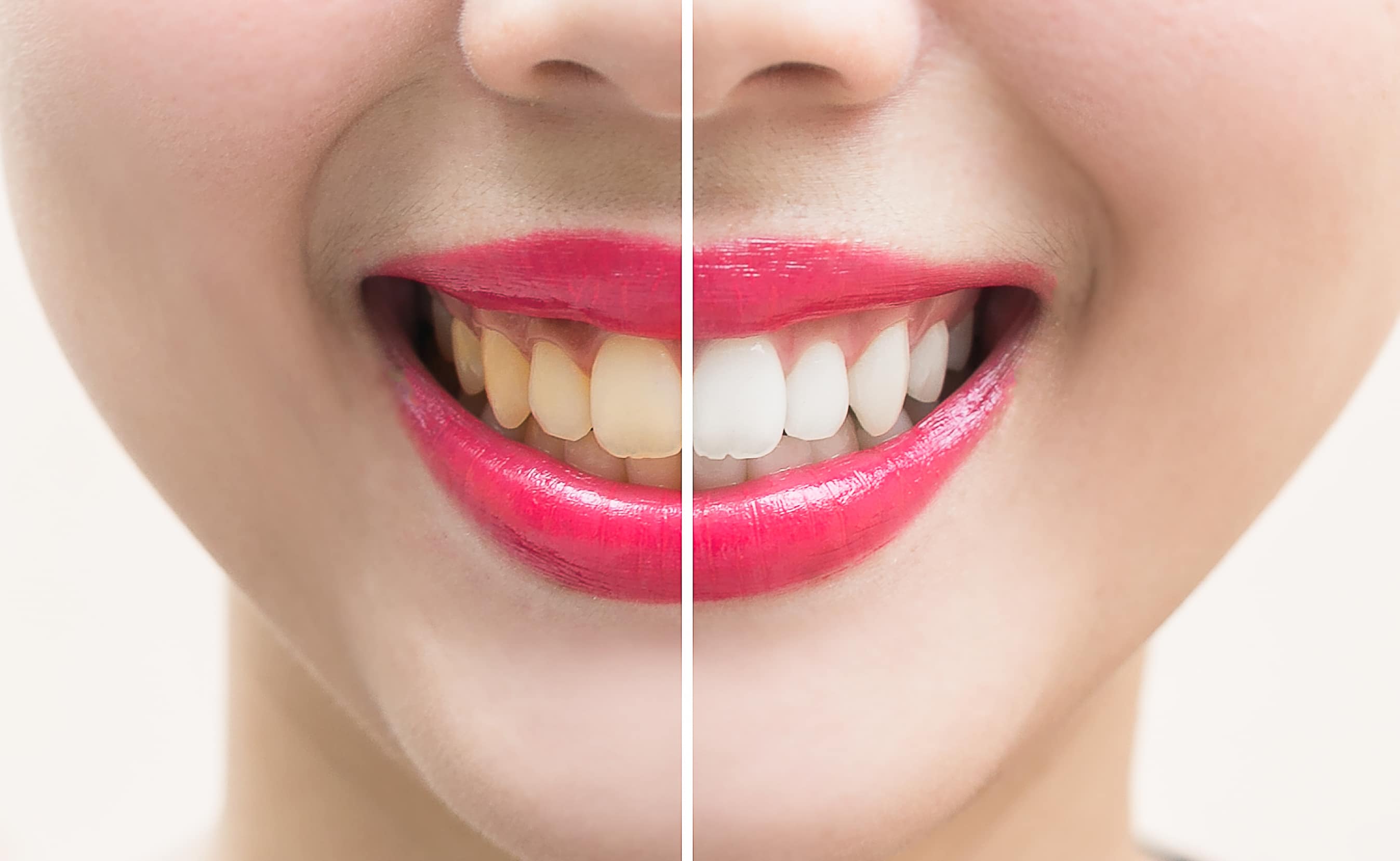 teeth whitening Pocatello ID