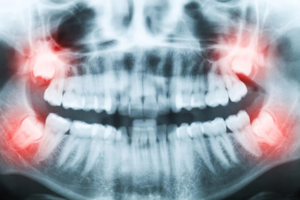 Exploring IV Sedation for Wisdom Teeth Removal