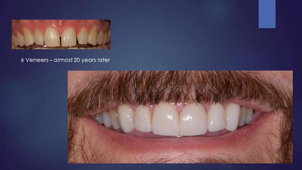 Dental Veneers: Answering 7 Frequently Asked Questions Dental Veneers: Answering 7 Frequently Asked Questions