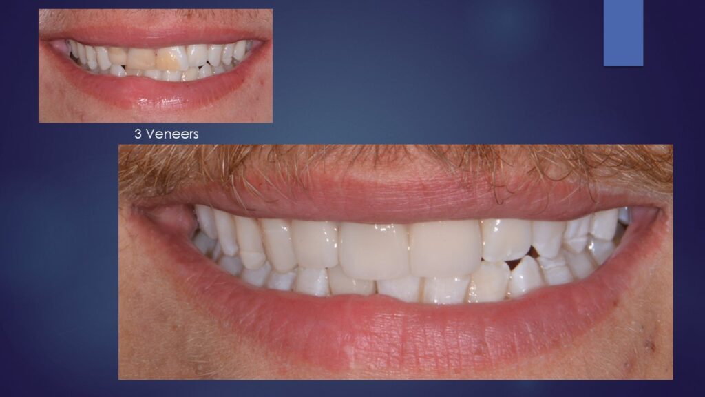 Dental Veneers: Answering 7 Frequently Asked Questions