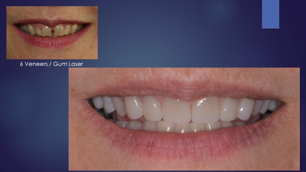 Dental Lasers For Soft Tissue Shaping And Versatile Applications Dental Lasers for Soft Tissue Shaping and Versatile Applications