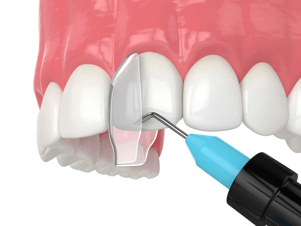 Transform Your Smile With Cosmetic Dental Bonding dental bonding Pocatello ID