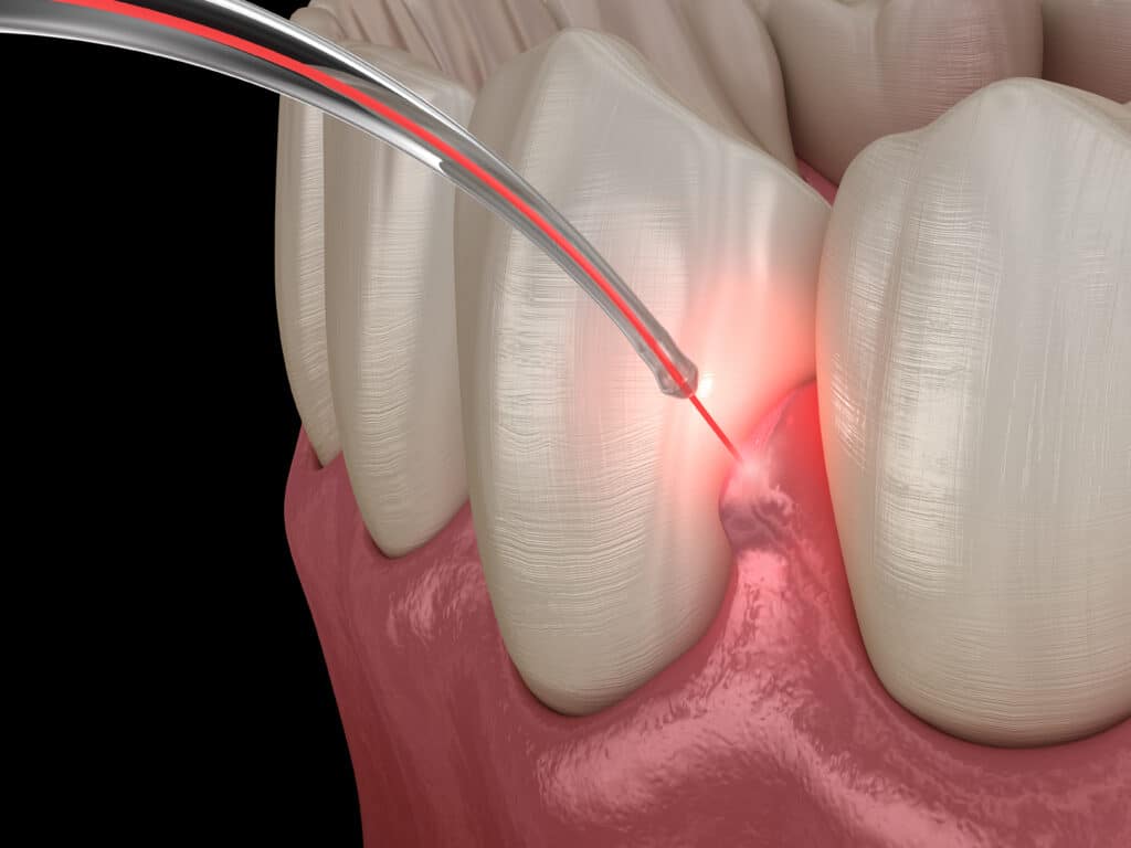 Dental Lasers For Soft Tissue Shaping And Versatile Applications Dental Lasers for Soft Tissue Shaping and Versatile Applications