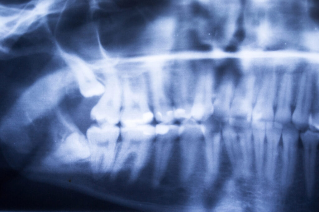 How To Know When It’s Time To Get Your Wisdom Teeth Out Get Your Wisdom Teeth Out