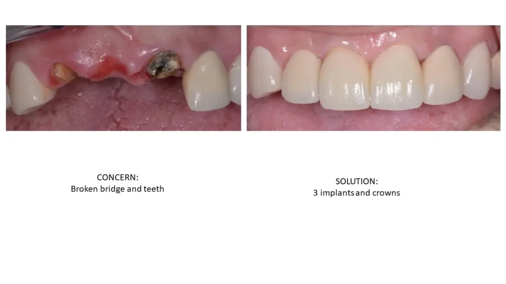 Get Answers To 8 Faqs About Dental Implants dental implant FAQs